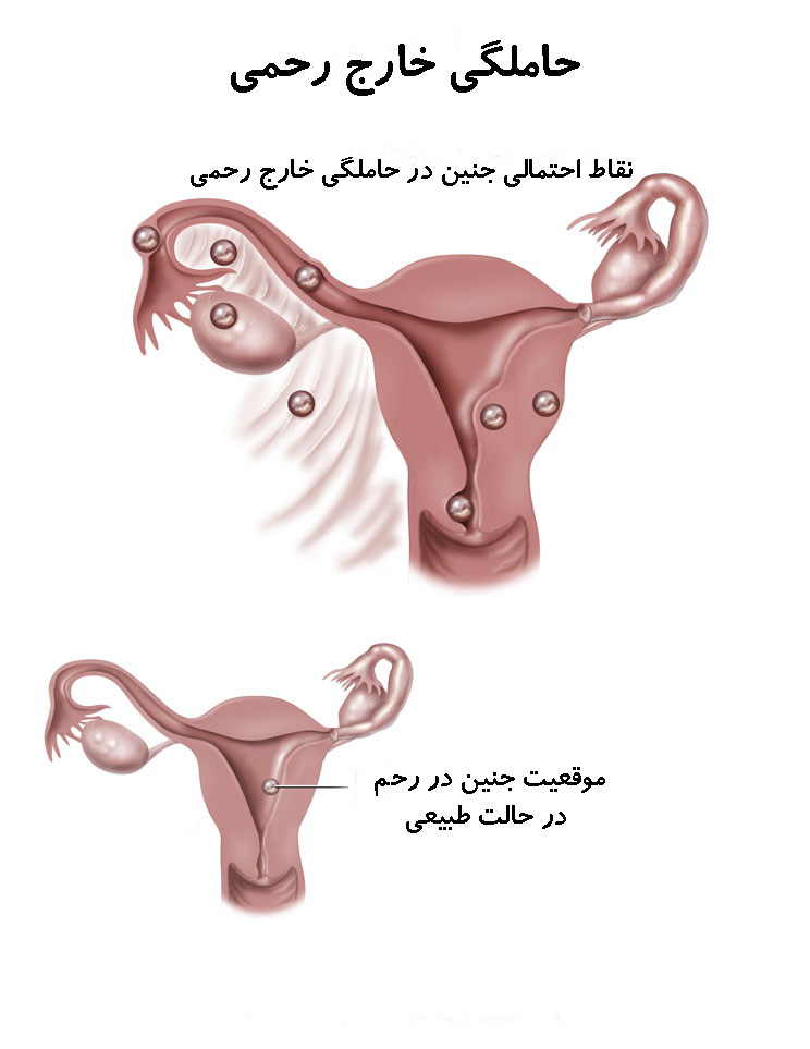 حاملگي خارج از رحم (اكتوپيك) علل حاملگي خارج از رحم